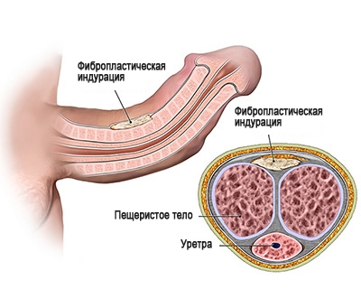 Болезнь Пейрони — причины искривления пениса и лечение